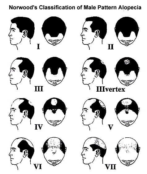 Norwood's Classification of Male Pattern alopecia