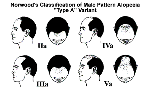 Norwood's Classification of Male Pattern alopecia Type A Variant
